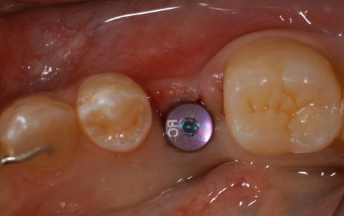 Techniques for abutment connection in the esthetic and non-esthetic zone 